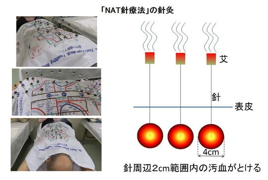 蔡先生のNAT針療法は二種類あります